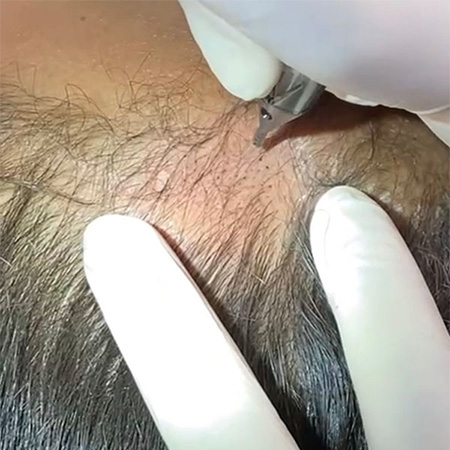 How Does Scalp Tattooing Work
